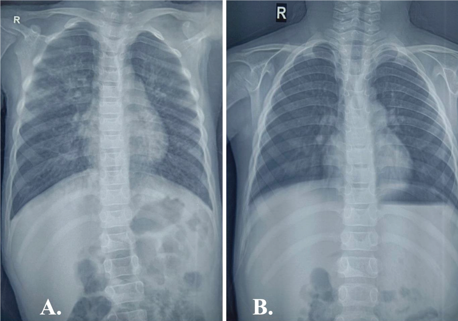 Panel A shows a frontal chest X-ray of a child with heterogeneous opacities localized to the right upper lung zone, suggestive of pneumonia. Panel B shows the same child’s follow-up chest X-ray with near-complete resolution of previous opacities, indicating improvement after treatment.